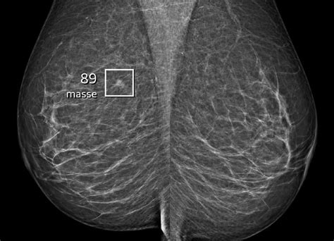 AI successfully helps detecting more breast cancers around .